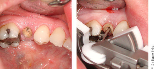 Sistema de extração de raiz dentária Benex Control - fotos do aplicativo